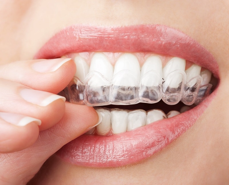 INVISALIGN®