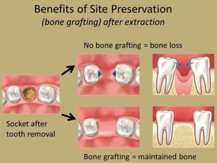 same day bone graft