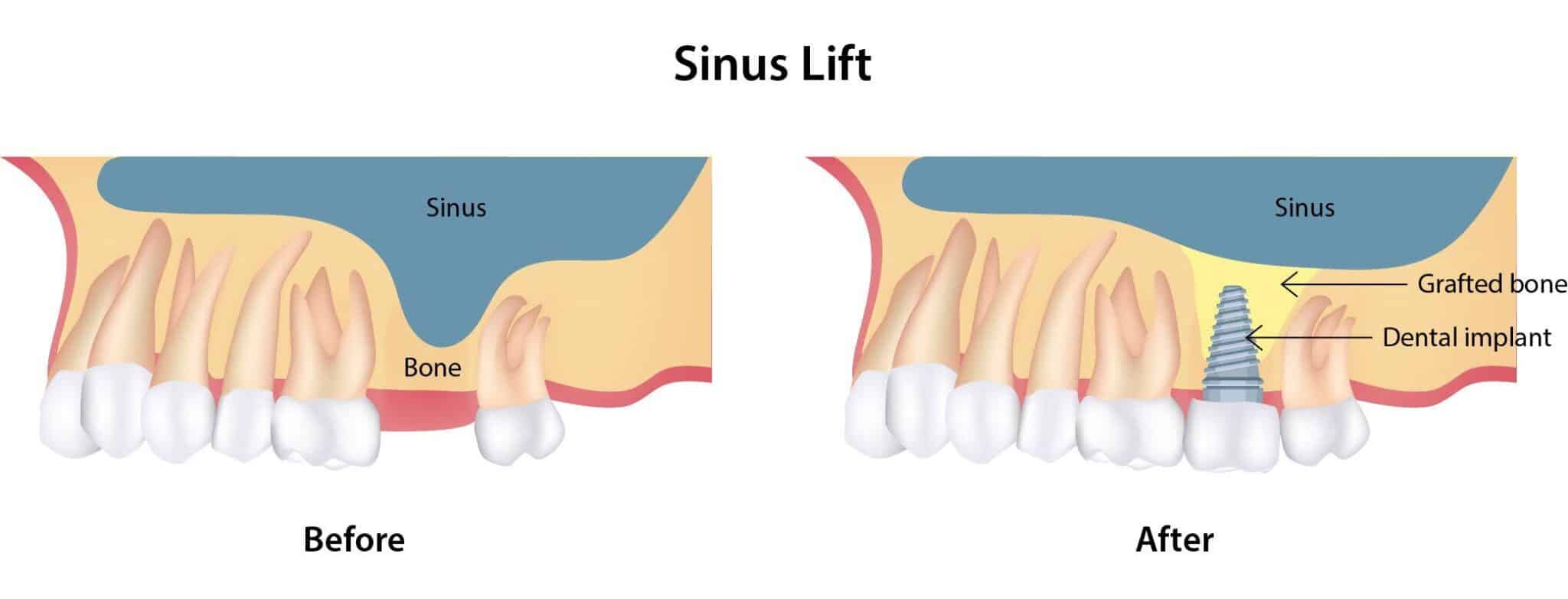 sinus lift scaled