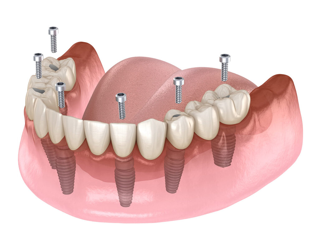 all on 4 implants