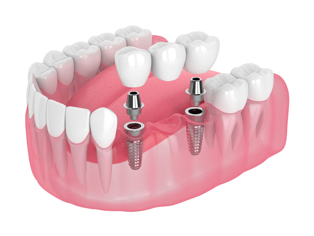 implant bridge