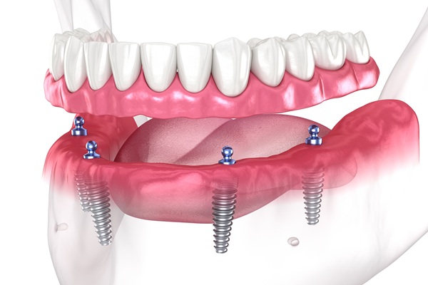 implant supported dentures
