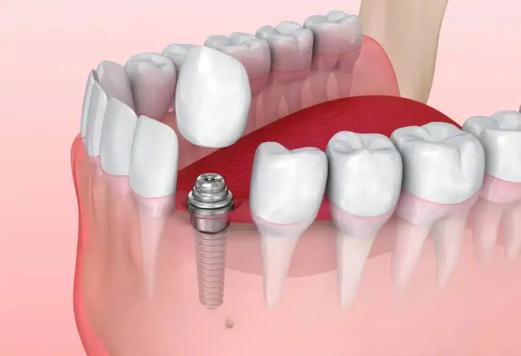 Can You Get All-on-4 Dental Implants With Bone Loss